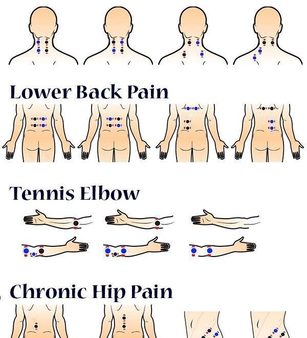 Correct Placement For Your TENS Machines 1 Electrode Pads Weight